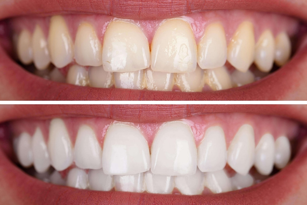 Bleaching vorher nachher