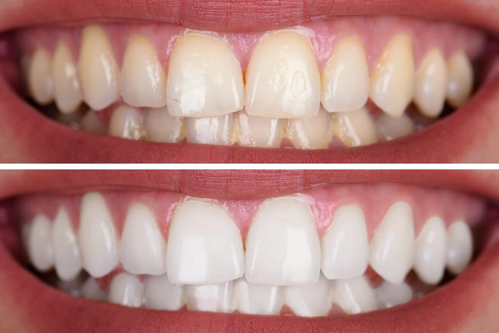 Ergebnis Zahnbleaching Königstein